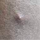 엠폭스 발진사진2