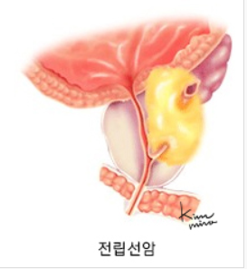 전립선암 모식도