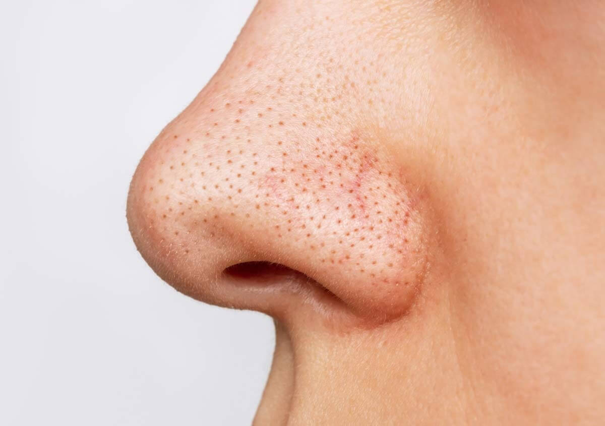 코 부위에 검게 박힌 블랙헤드 클로즈업 사진으로 모공 막힘과 피지 산화 상태를 보여주며 올바른 클렌징과 관리 방법의 중요성을 설명