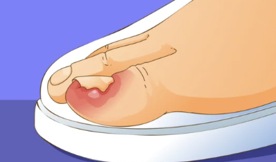 내성발톱
