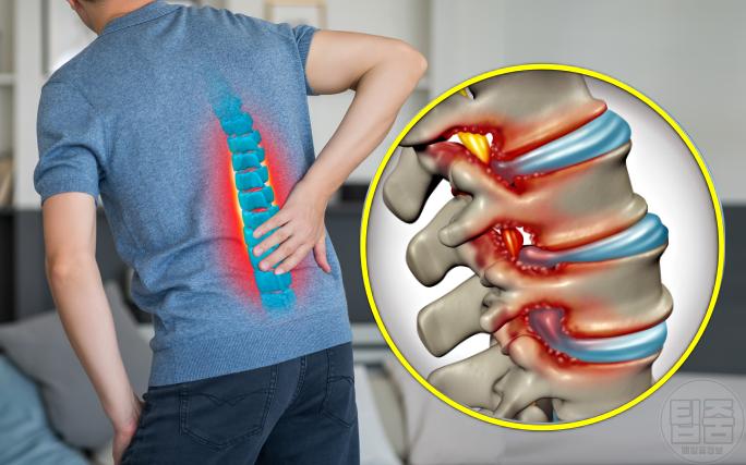 허리가 찌릿 아플때 척추관협착증 증상 원인 추간판탈출증