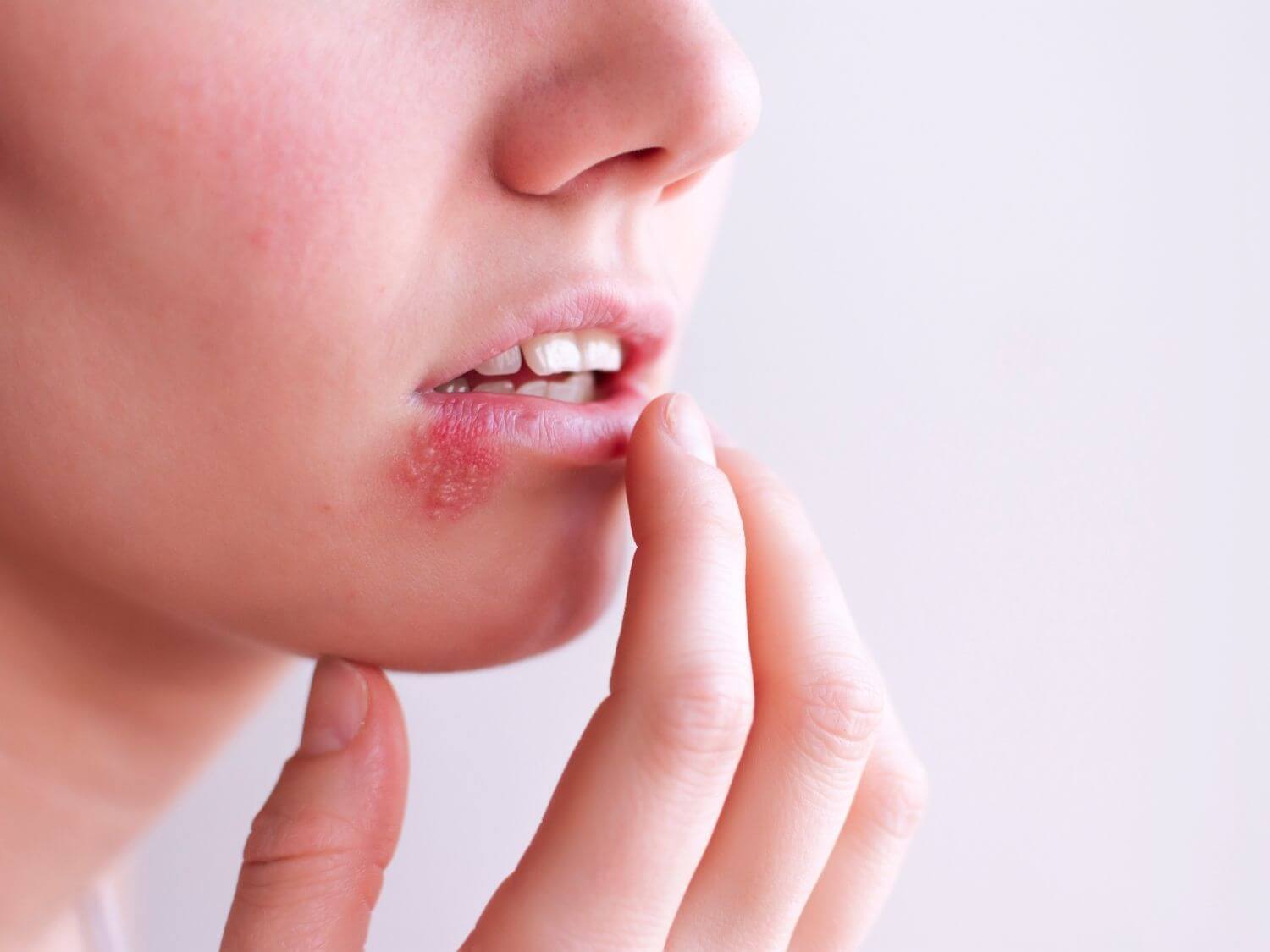 뇌전증 원인 헤르페스