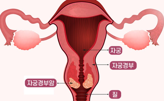 자궁경부암의 백신 접종 시기와 부작용 관련 이미지