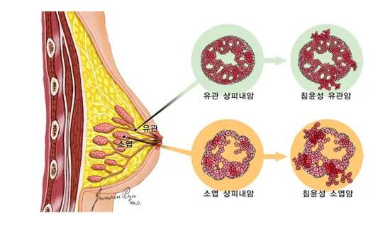 유방섬유종 증상사진