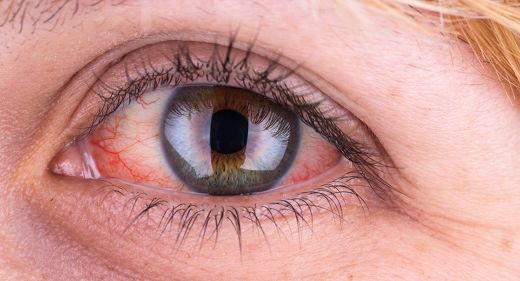 눈이 충혈되는 이유