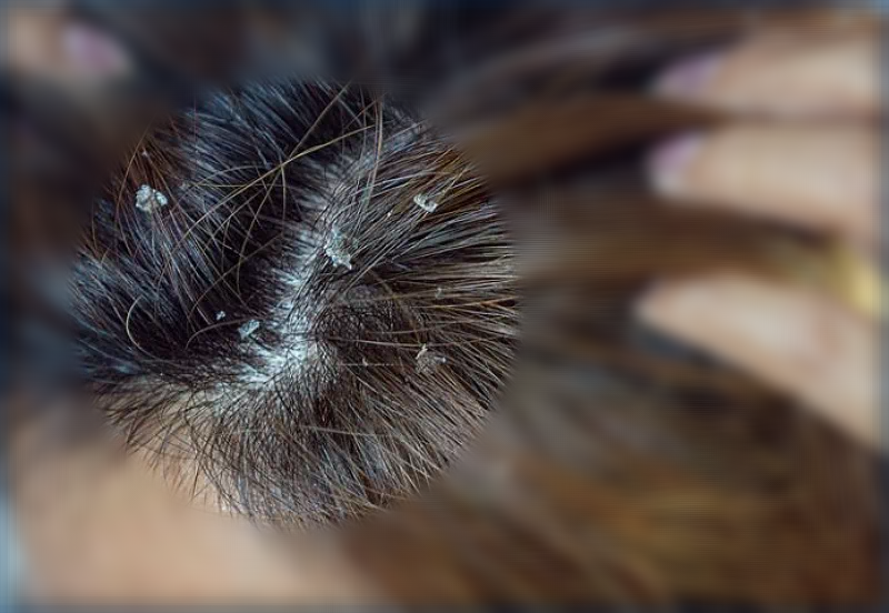 비듬이 생기는 이유