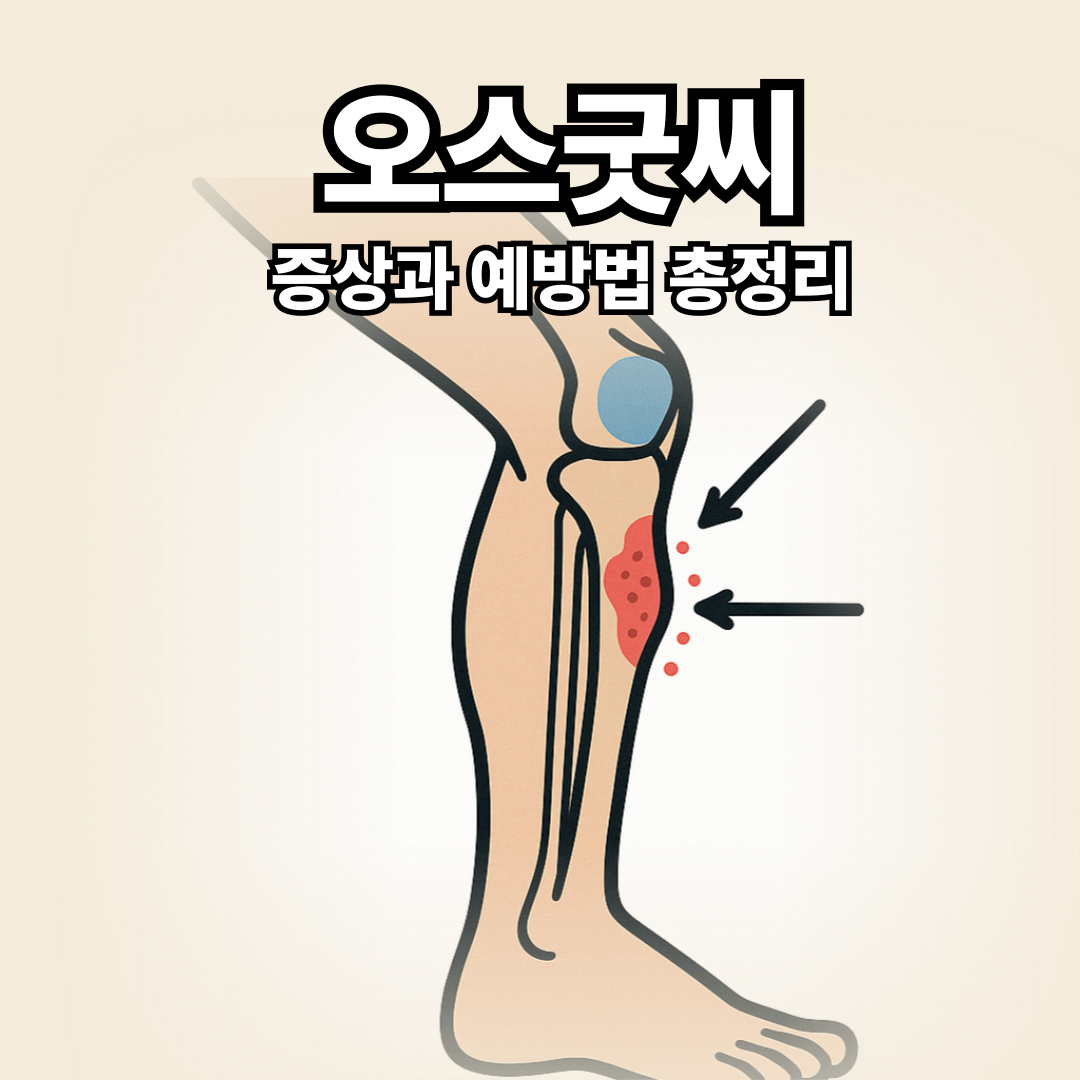 오스굿씨 증상과 예방법 총정리