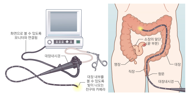 대장내시경 시행