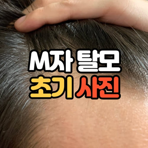 m자 탈모 초기 사진