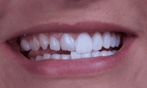 라미네이트 시술 : 비용/가격, 수명, 과정, 시술후 관리방법