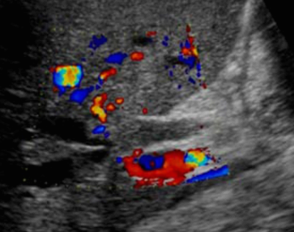 간외담관암(extrahepatic cholagiocarcinoma)
