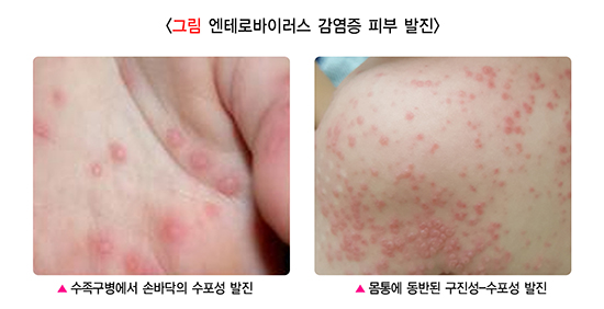 수족구병