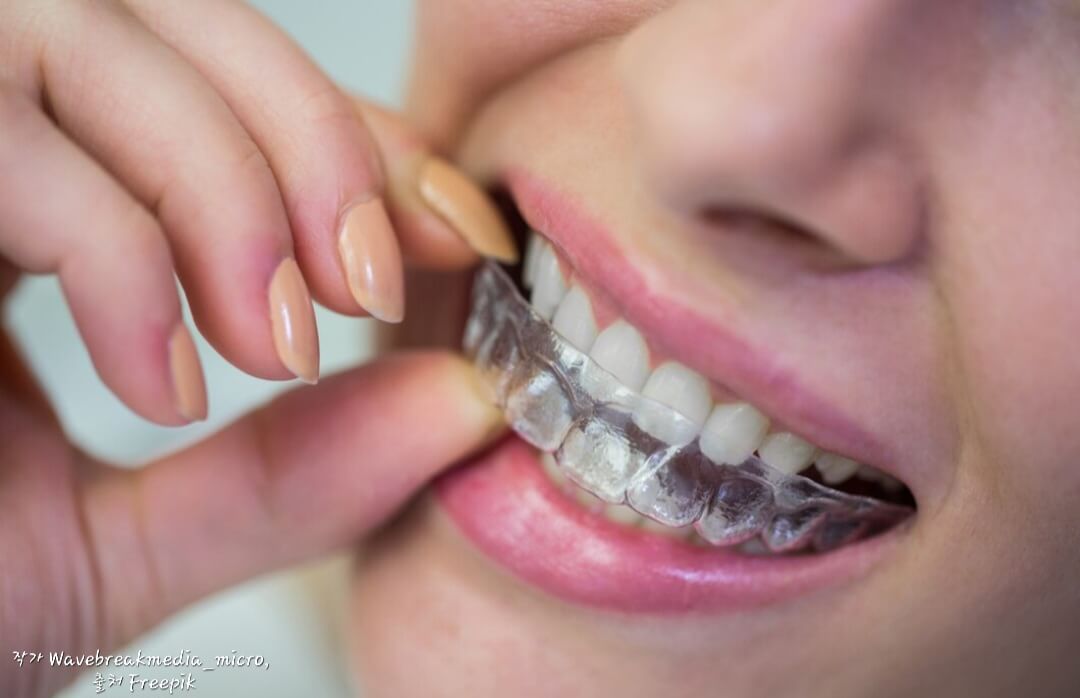투명 치아 교정 장치 끼는 법
