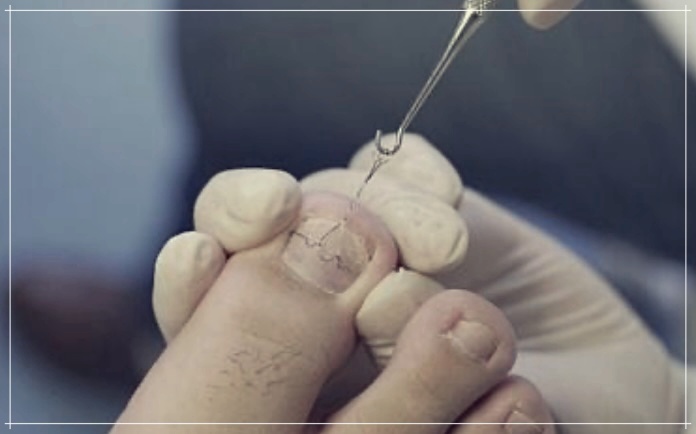 발톱 두꺼워지는 원인과 대처법