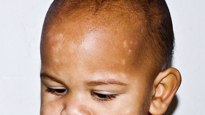 백반증 완벽 가이드