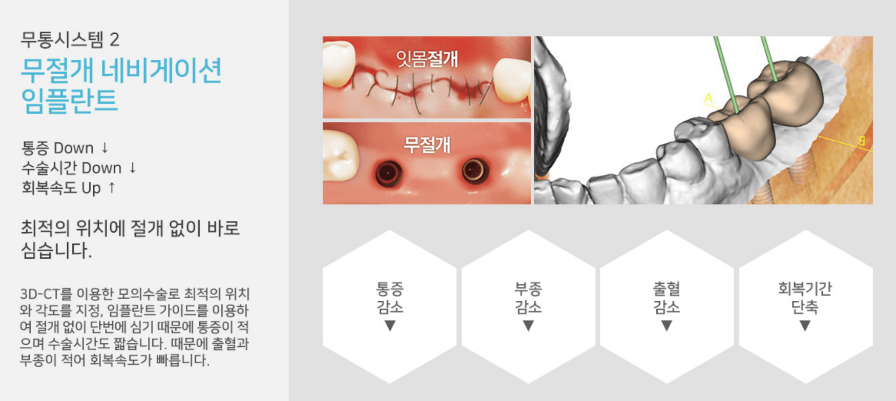 강남-크림치과-김정란원장-임플란트