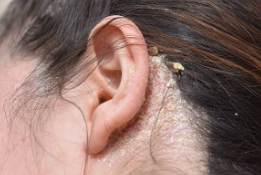 지루성 두피염 증상4