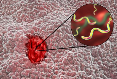 위궤양에 좋은 음식 증상 원인 치료 관리방법