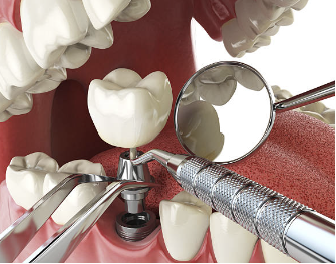 어금니 임플란트