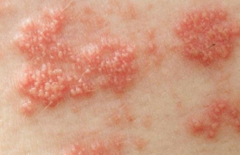 대상포진 사진입니다.