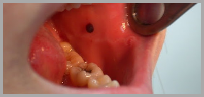 입안 피멍울 원인 치료방법