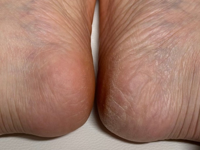 발 각질 간단하게 제거하는법