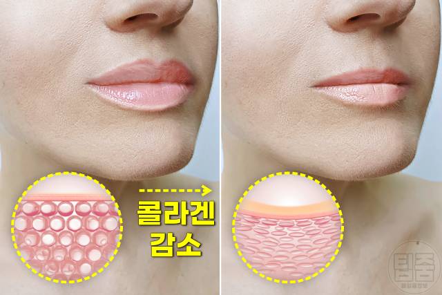 얼굴 노화 증상,피부노화 증상,피부 얇아짐