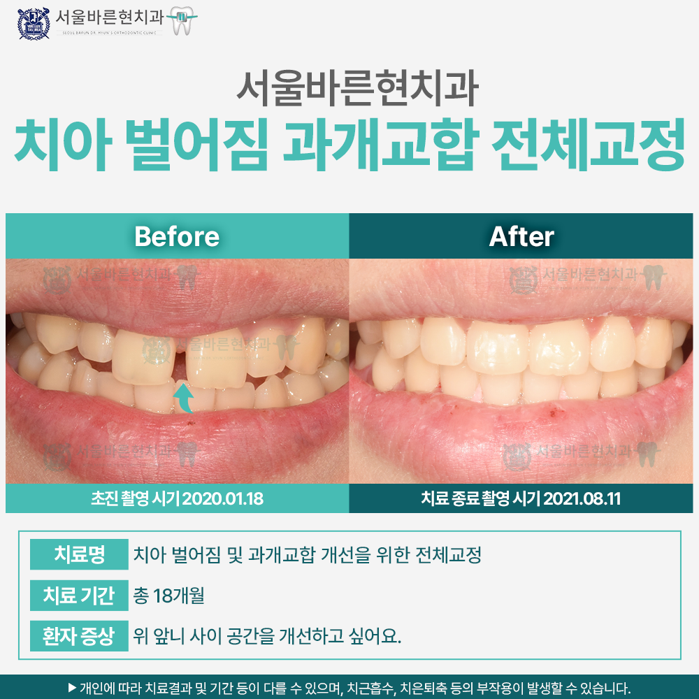 해운대과개교합교정