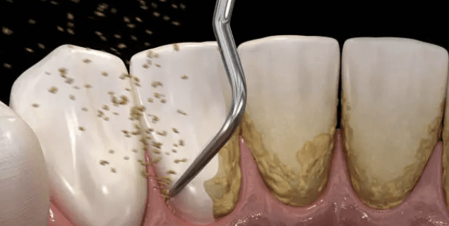치석제거 스케일링부터 보험은 안되는 파우더스케일링 비교정리