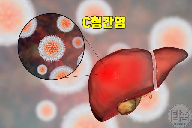 간암 의심 증상 c형간염