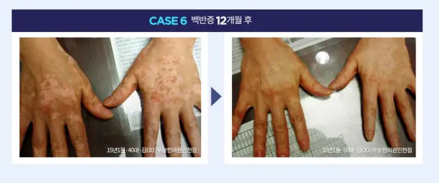 백반증 전문 우보환