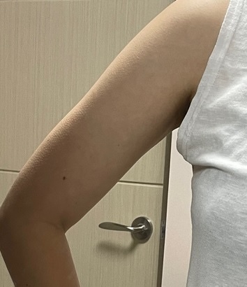 팔뚝 지방분해 주사 후기