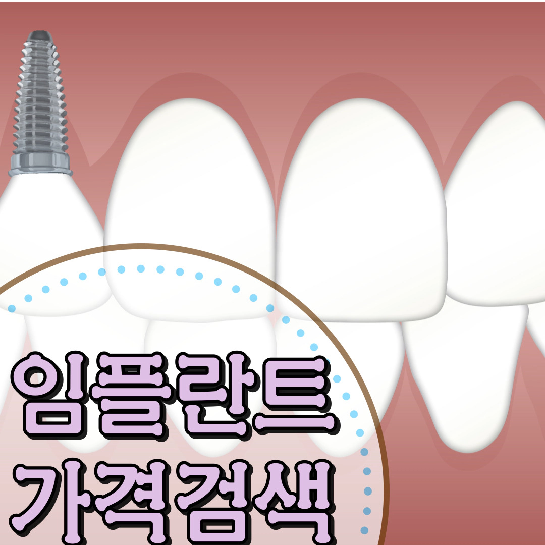[임플란트] 가격 검색(병원 별)-오스템 임플란트 장단점