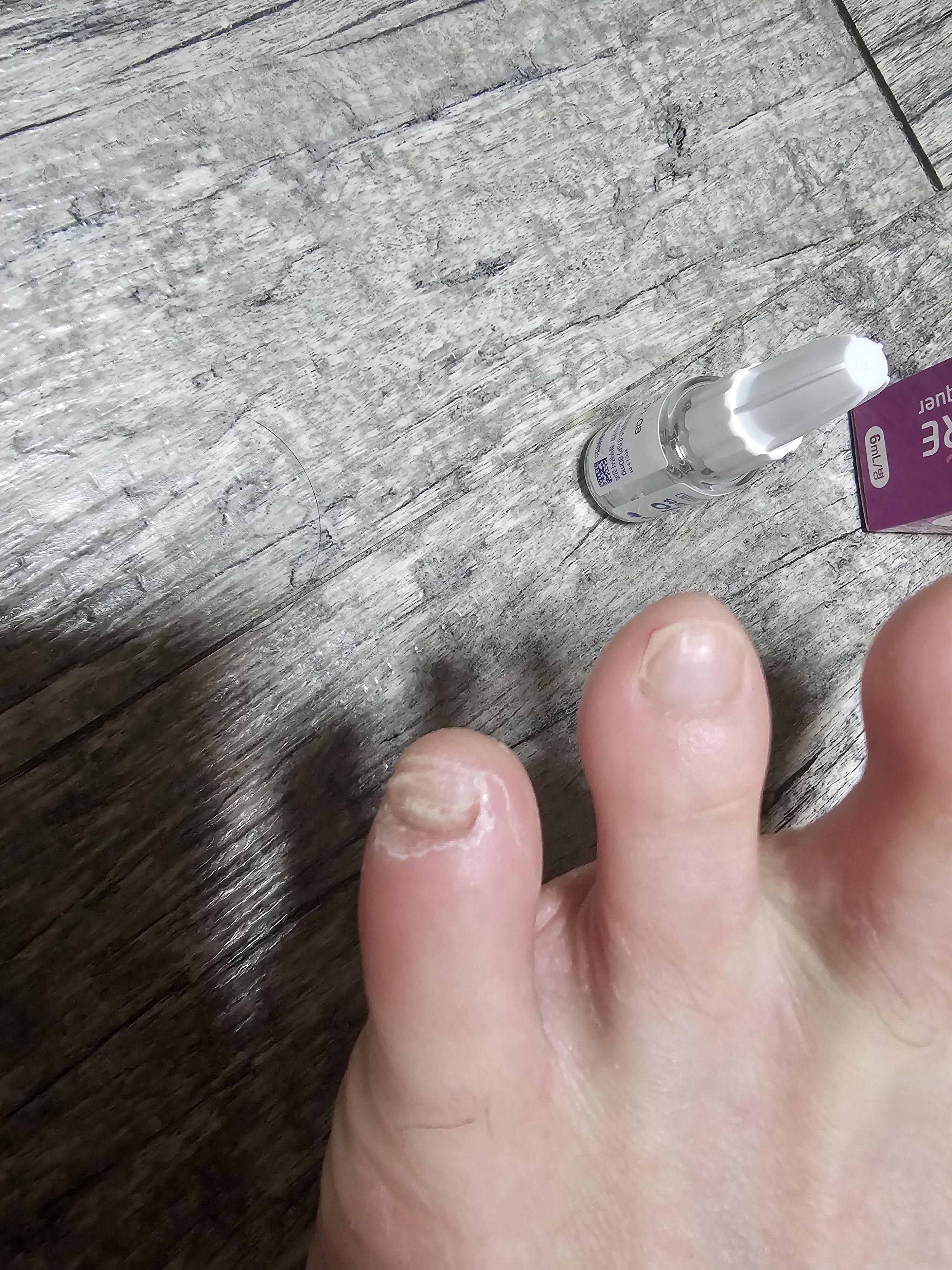 무좀 치료약 유한이지케어네일라카