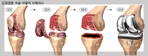 인공관절수술단계