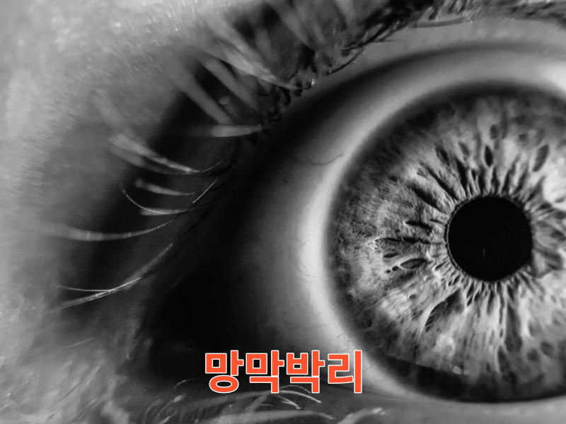 망막박리
