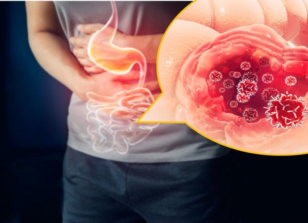 대장암 초기증상