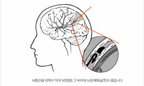 뇌경색 이미지