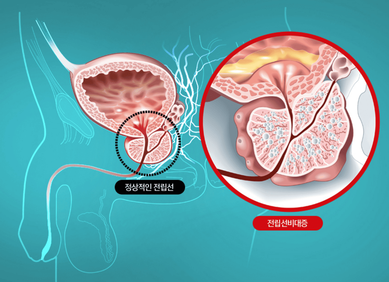 전립선비대증치료 전립선비대증수술비용 비뇨기과남성수술비용
