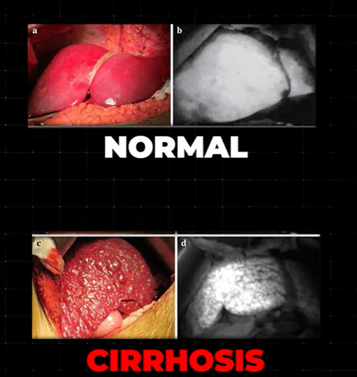 지방간 없애는 방법
