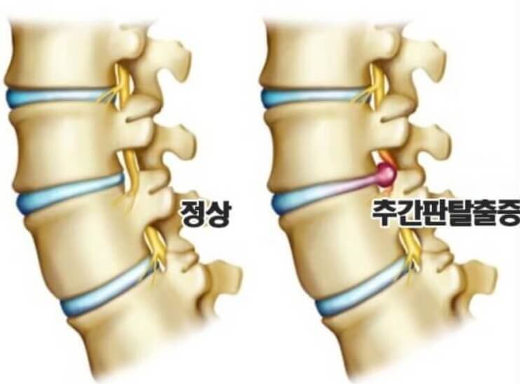 추간판 위치