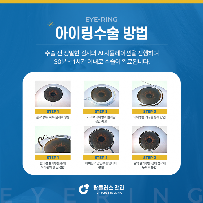 아이링-시술-효과-과정-소요시간-가격-실비-(+제거-크기-색-선택-가능-여부)