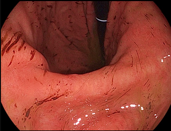 출혈성위염1_출처:EndoToday