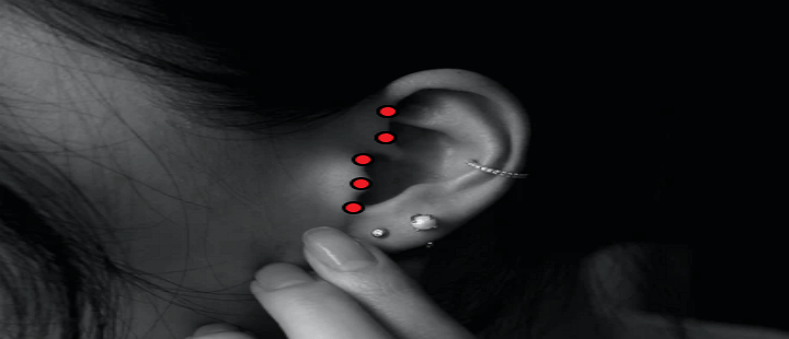 절개하는 귀의 위치