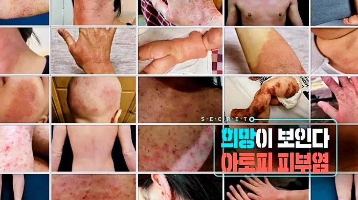 생로병사의 비밀 872회 희망이 보인다, 아토피 피부염 치료 및 치료제 비용, 보험 범위 정보 방법