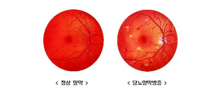 정상적인 망막과 당뇨병성 망막증이 있는 망막을 나란히 그려 놓고 비교를 하고 있는 이미지 사진