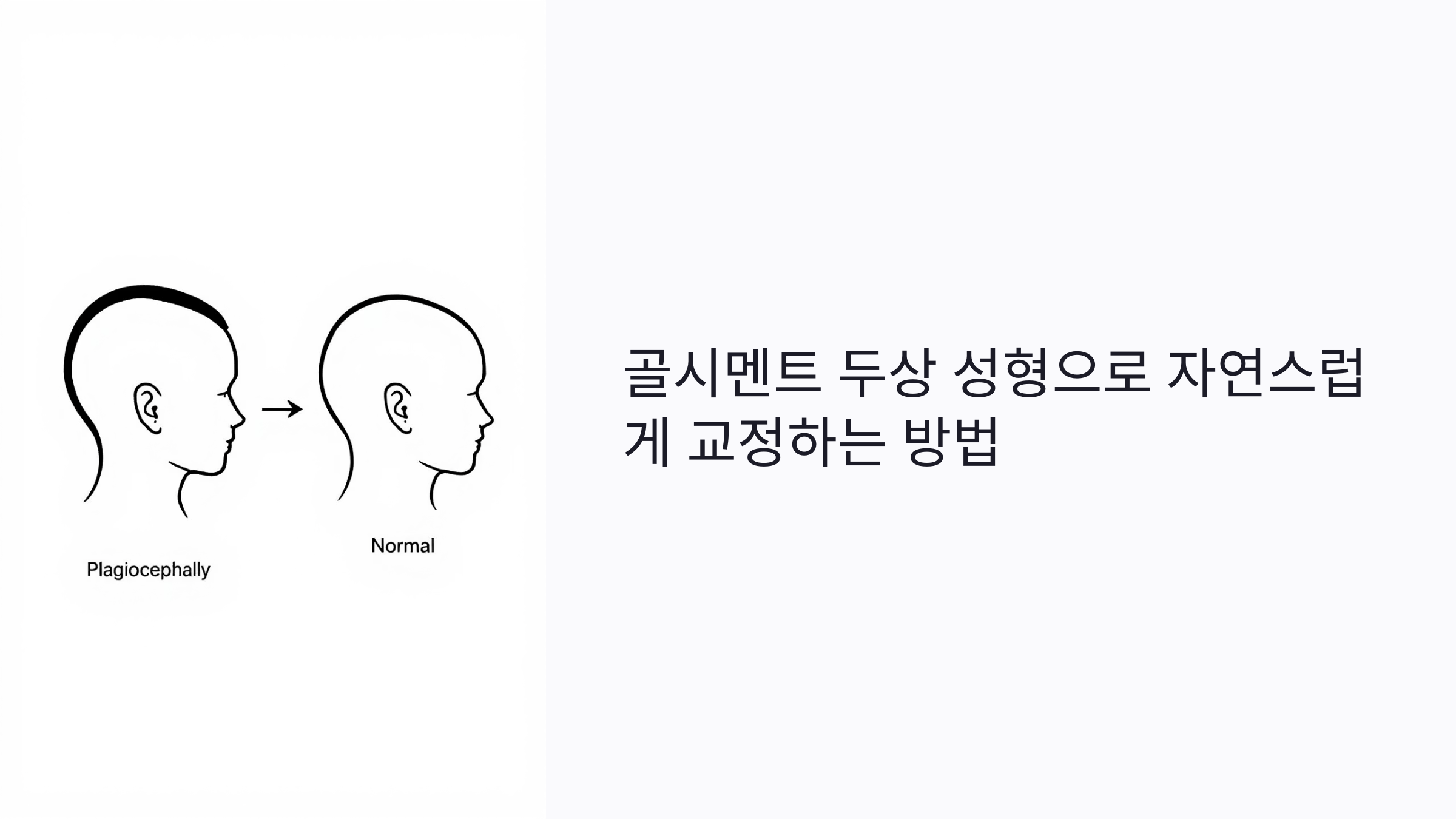 뒤통수 납작한가요? 골시멘트 두상 성형으로 자연스럽게 교정하는 방법