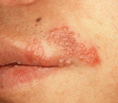 입술 헤르페스 증상