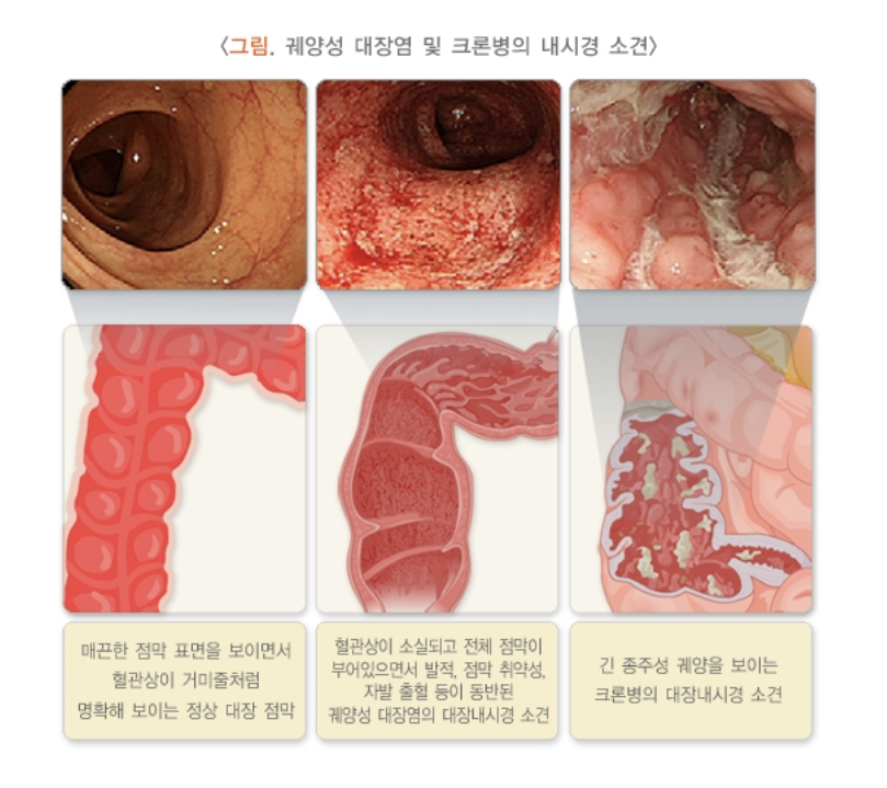 대장염 및 크론병 내시경 소견