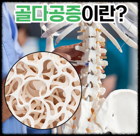 골다공증 예방과 관리